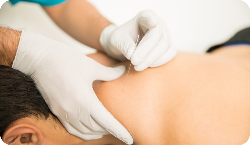 Dry Needling Therapy